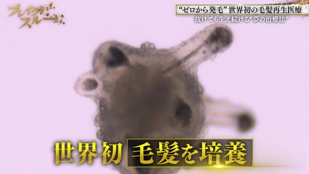 世界初の薄毛治療“毛髪再生医療”で、自分の髪を“ゼロから発毛”
