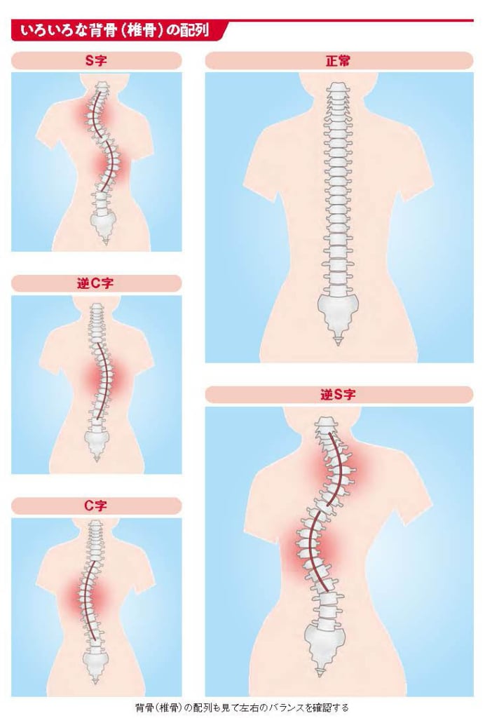 いろいろな背骨の配列【スポーツ障害予防の教科書】