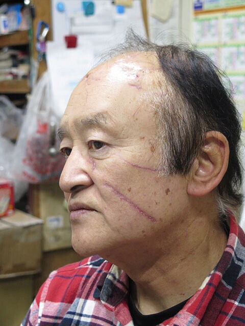 北秋田市鷹巣でクマに襲われた湊屋さん。傷は頭部を中心に体中に及び、被害から1ヵ月を経た今も、彼の顔には生々しい爪痕と噛み痕が残っている