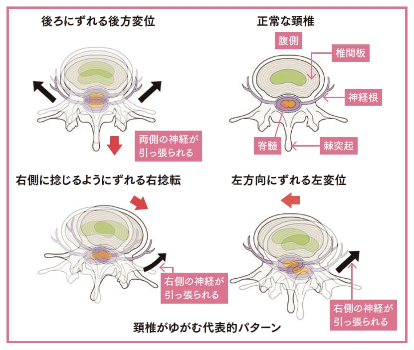 頚椎がゆがむ代表的パターン【背骨コンディショニング】