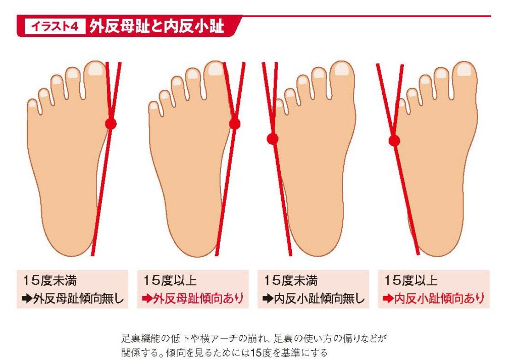 外反母趾と内反小趾【スポーツ障害予防の教科書】