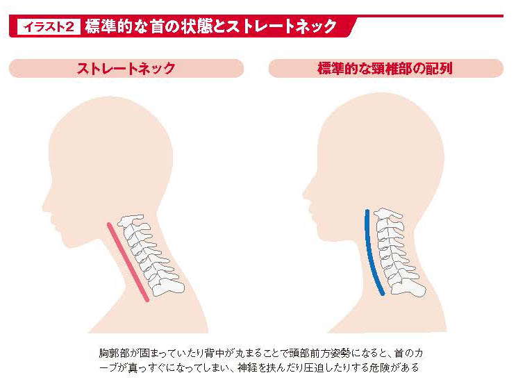 標準的な首の状態とストレートネック【スポーツ障害予防の教科書】