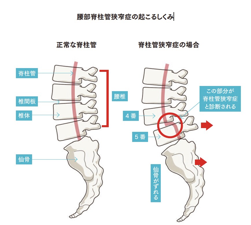 腰部脊柱管狭窄症の起こるしくみ【背骨コンディショニング】