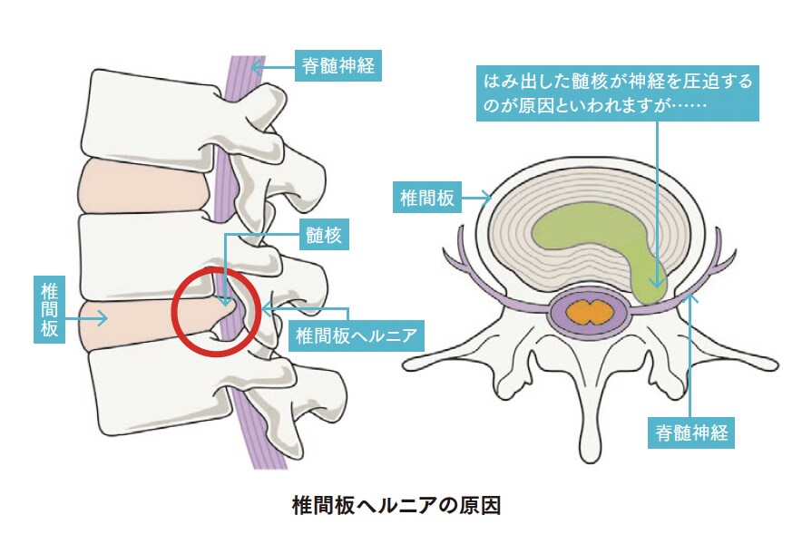 椎間板ヘルニアの原因【背骨コンディショニング】